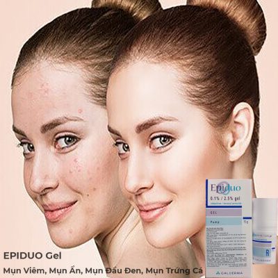 Kem Trị Mụn Epiduo Gel Galderma